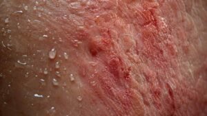 Infection Becomes A Risk