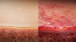 Moisture Associated Skin Damage In Real Life