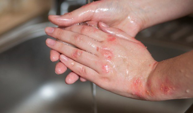 When Hand Irritation Needs Attention